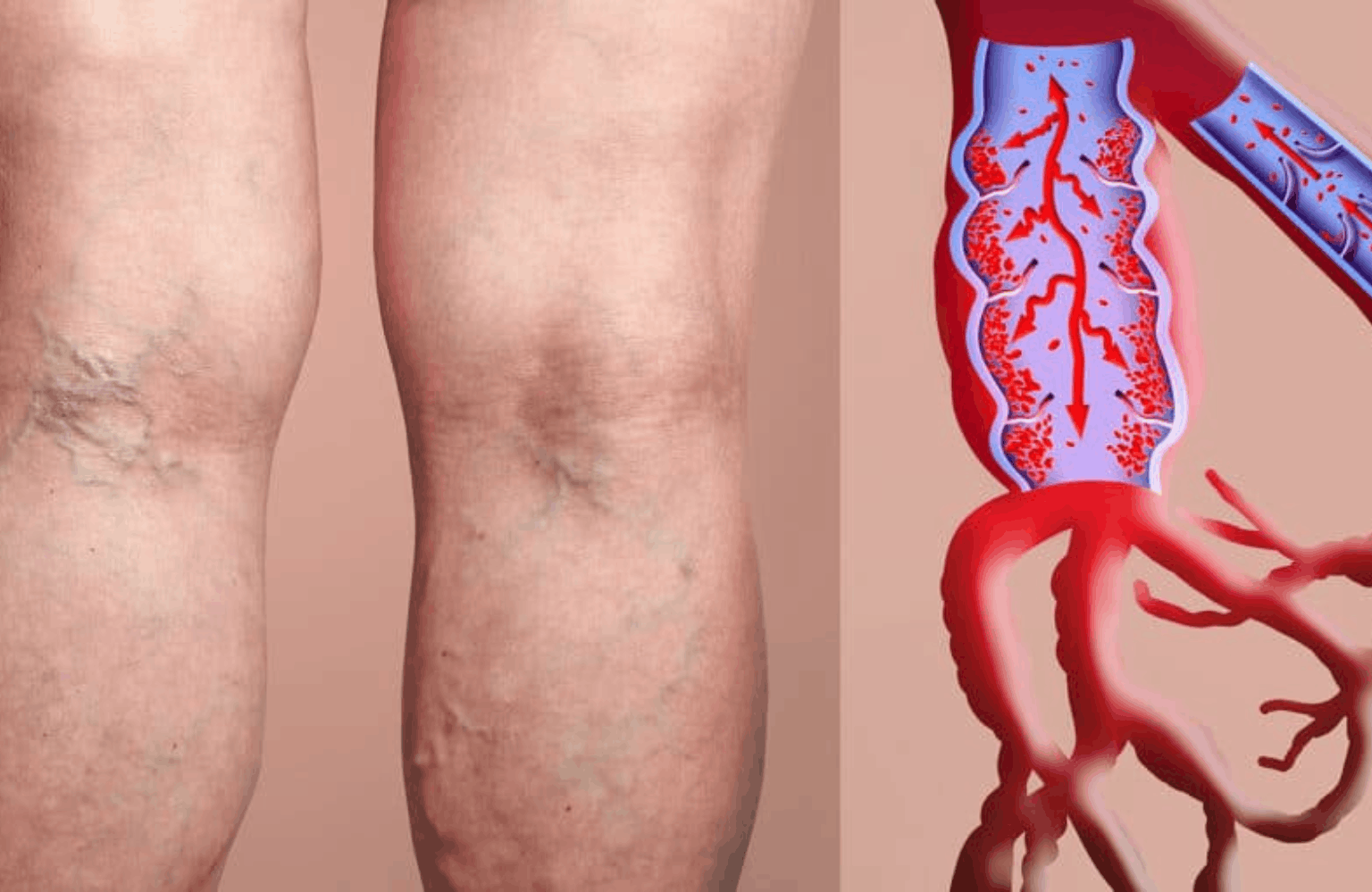 Deep Vein Thrombosis Symptoms and Causes Ayurvedic Treatment | Causes & Symptoms