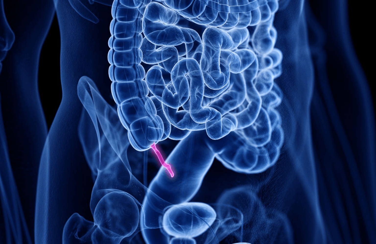 Appendicitis Ayurvedic Treatment | Causes & Symptoms