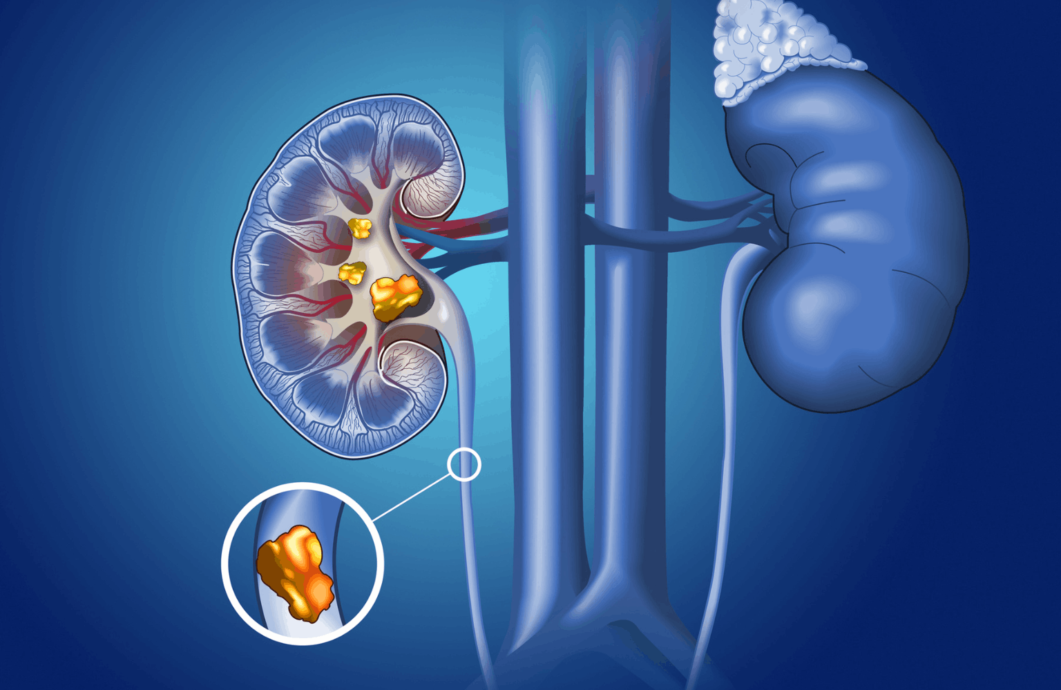 Kidney stones Symptoms and Causes Ayurvedic Treatment | Causes & Symptoms