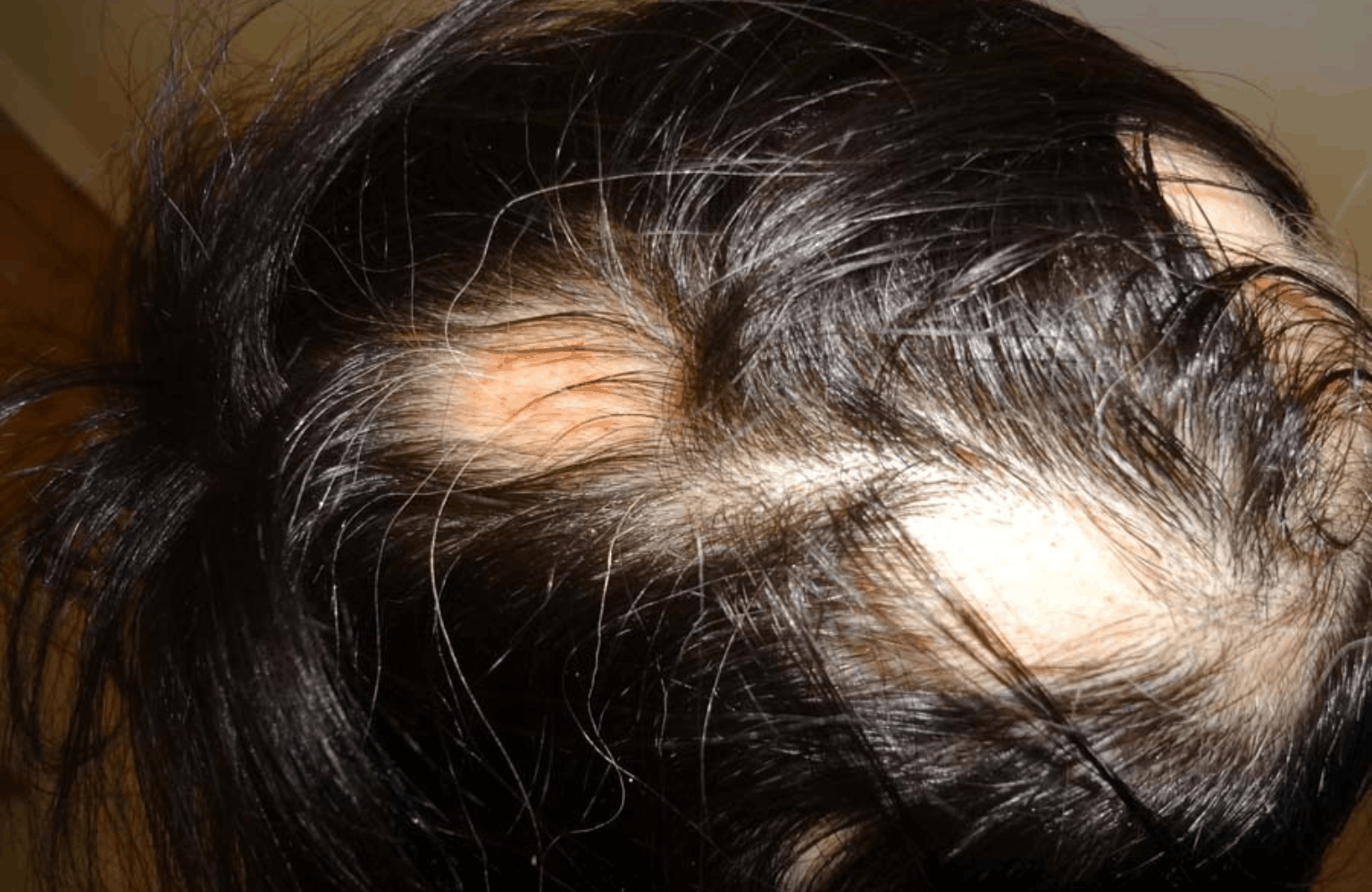 Alopecia Ayurvedic Treatment | Causes & Symptoms