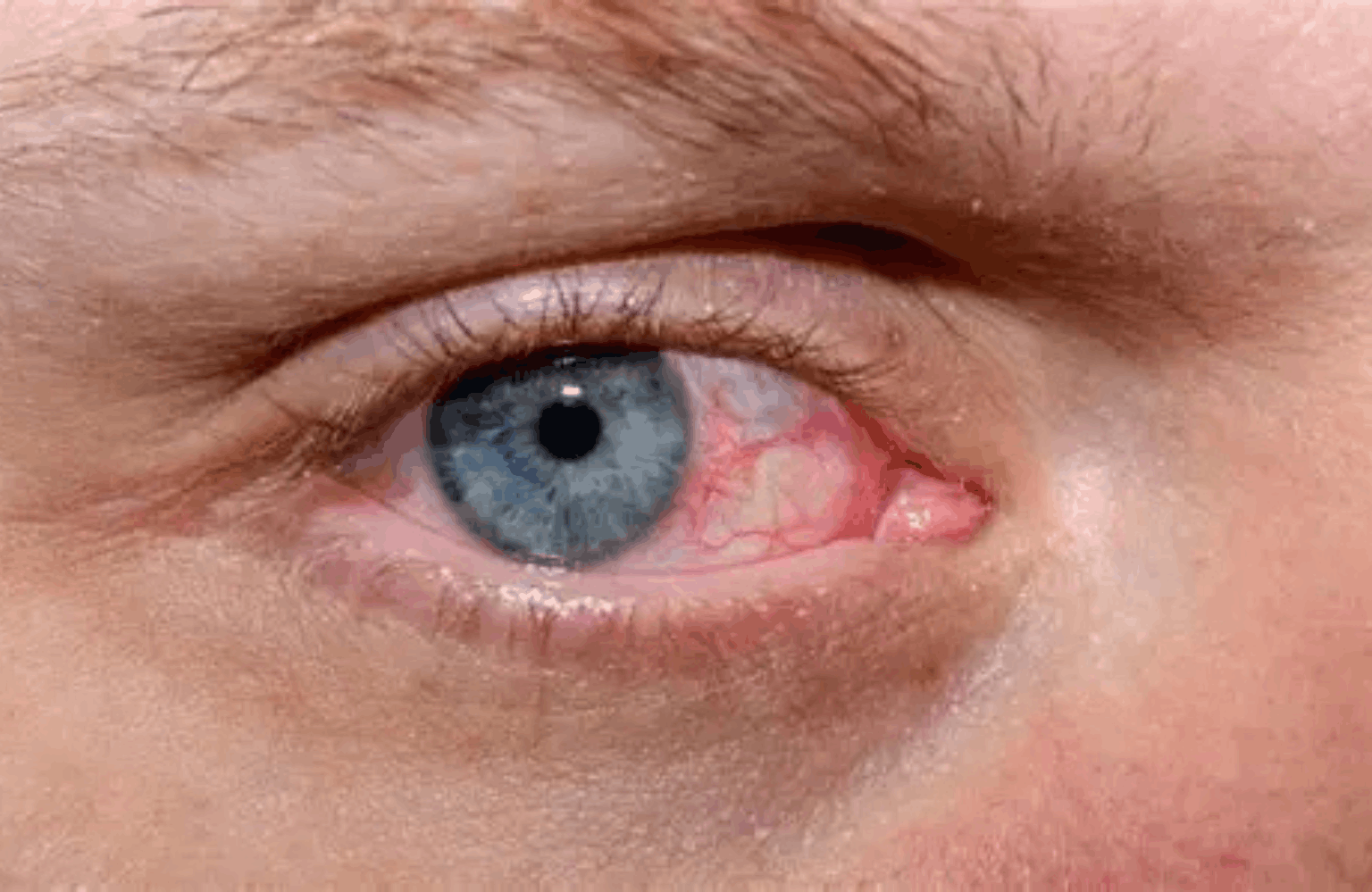 Dry eye Ayurvedic Treatment | Causes & Symptoms