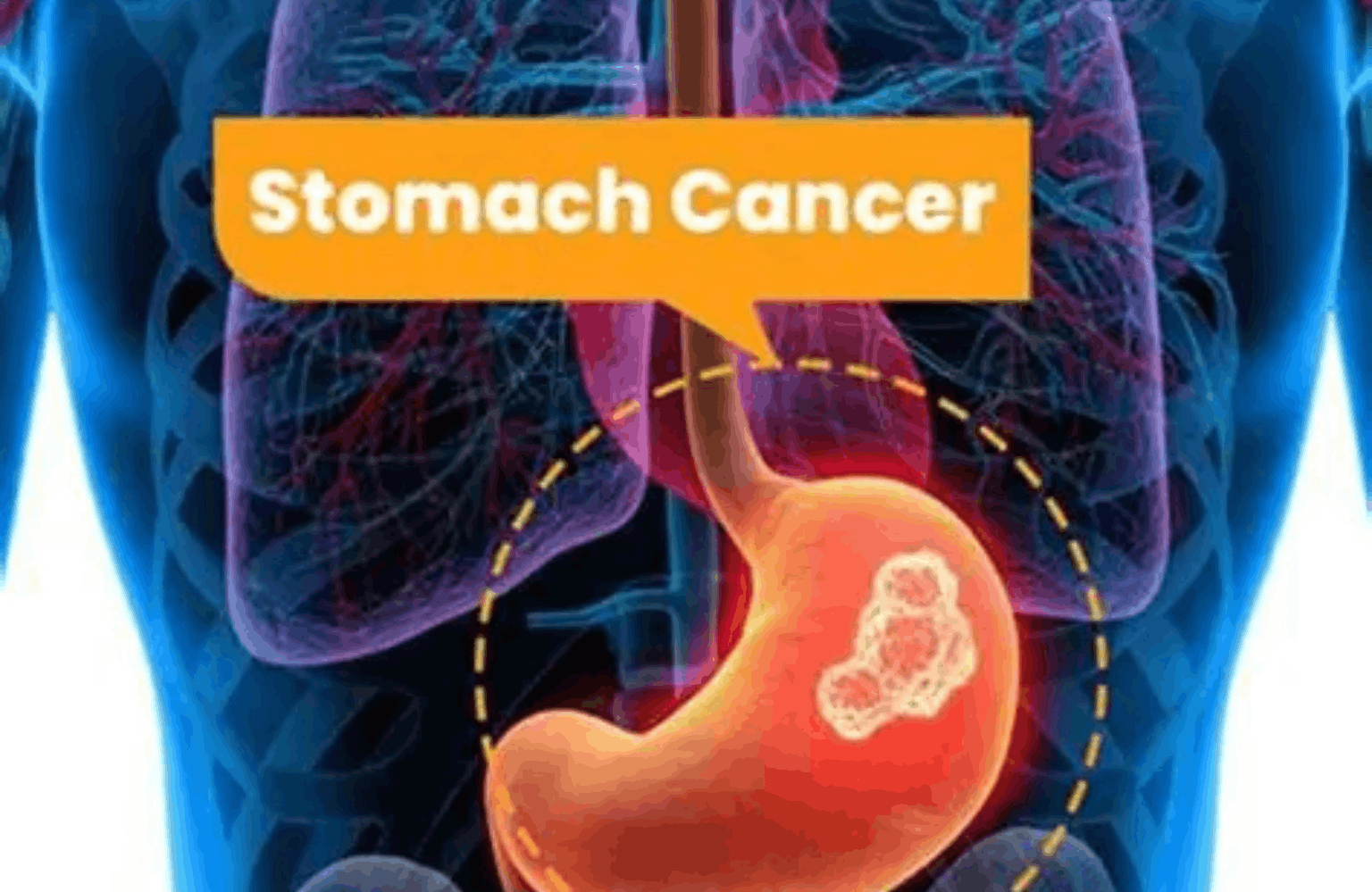 Stomach cancer Ayurvedic Treatment | Causes & Symptoms