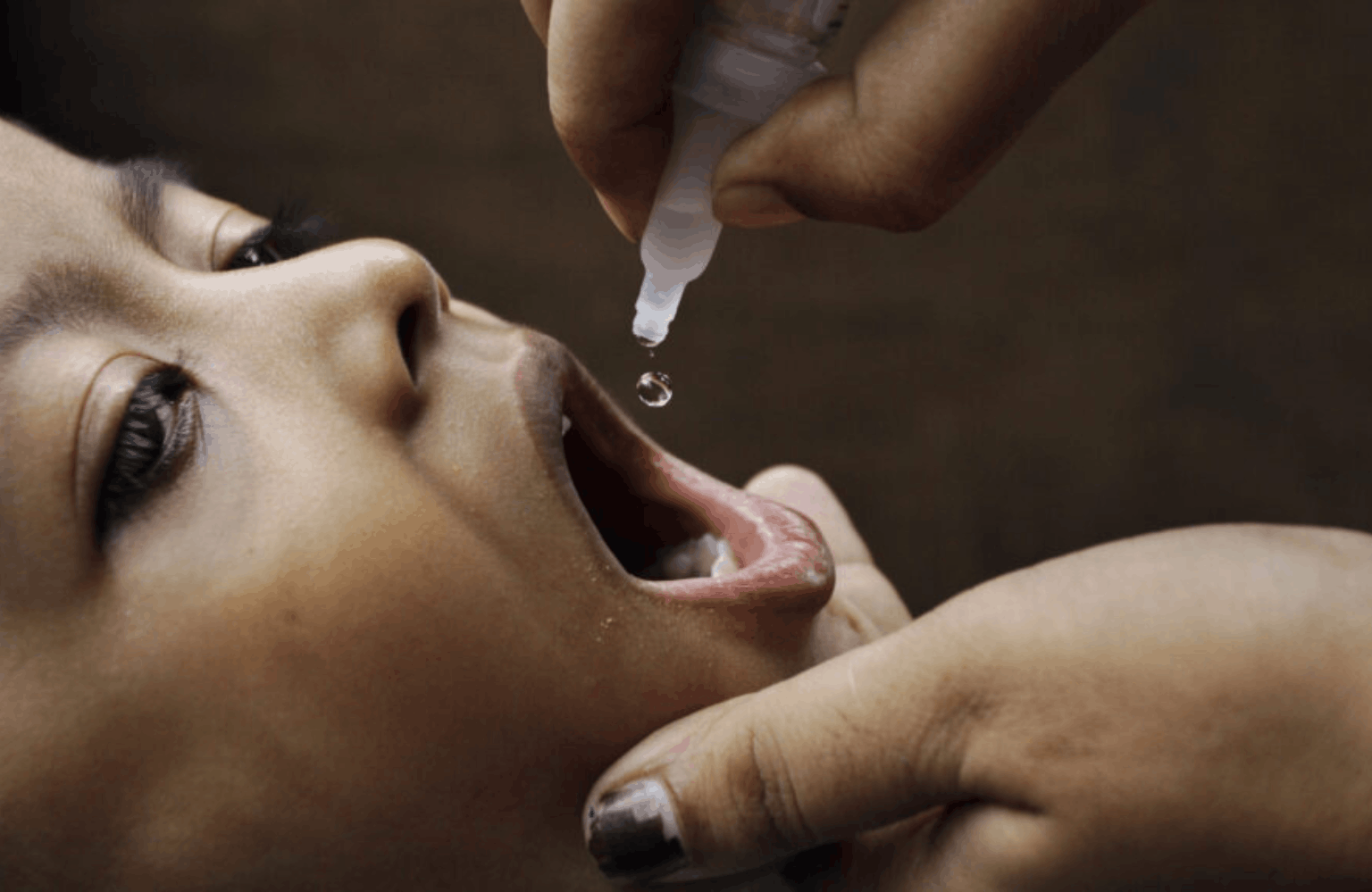 Diphtheria Ayurvedic Treatment | Causes & Symptoms