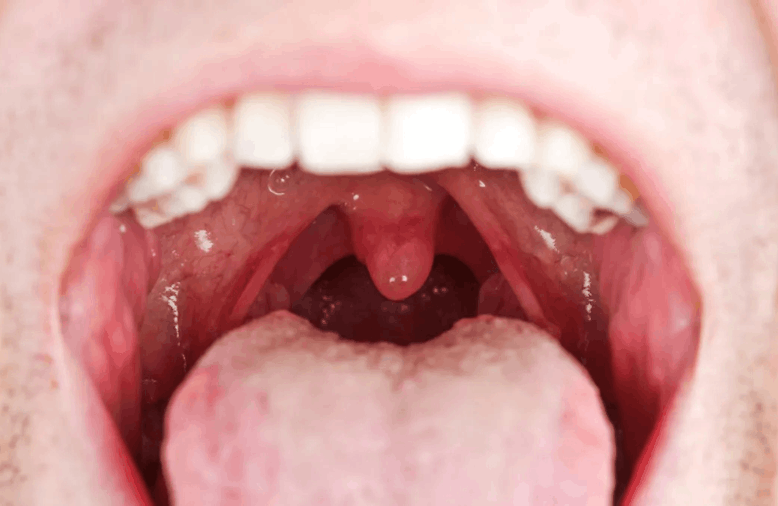 Throat infection Home Remedies and the Ayurvedic View Ayurvedic Treatment | Causes & Symptoms