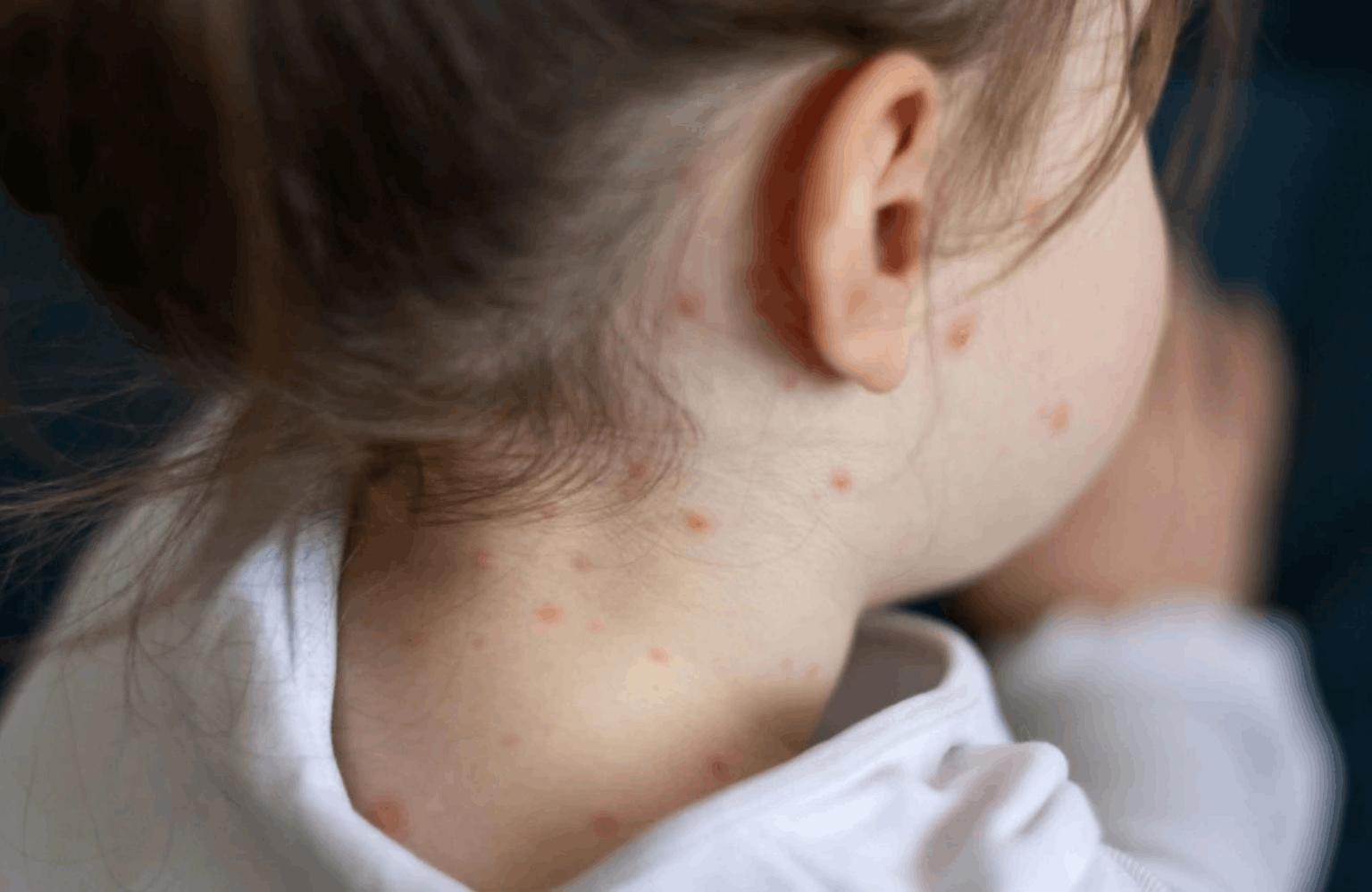Measles Ayurvedic Treatment | Causes & Symptoms