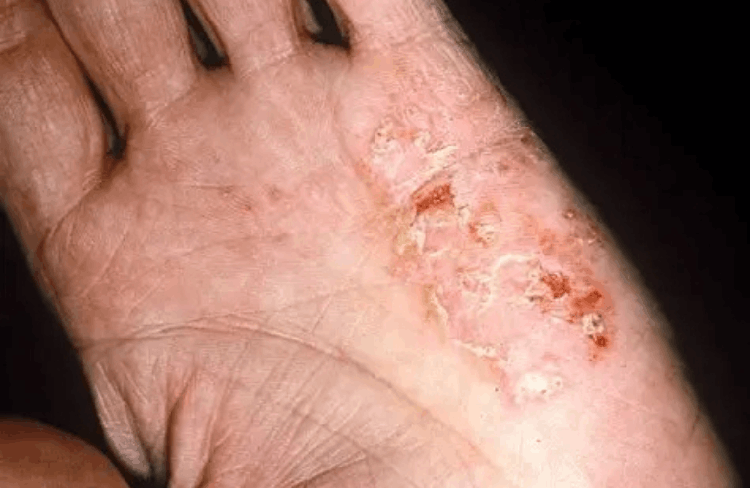 Eczema Ayurvedic Treatment | Causes & Symptoms