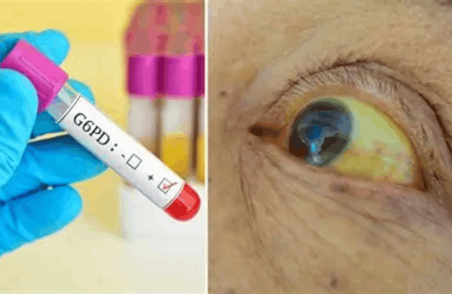 G6PD Deficiency Causes and Symptoms Ayurvedic Treatment | Causes & Symptoms