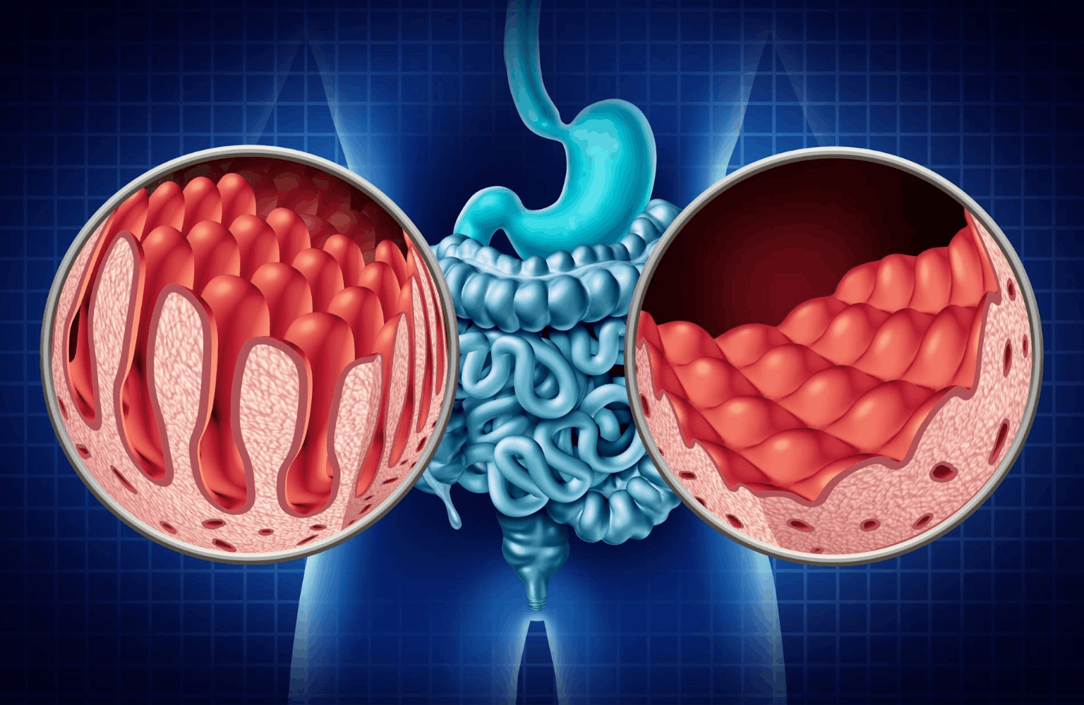Celiac disease Symptoms and Causes Ayurvedic Treatment | Causes & Symptoms