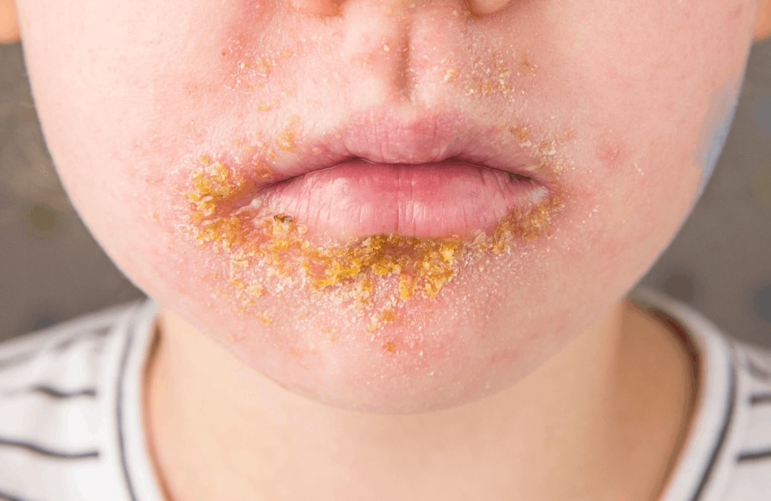 Impetigo Ayurvedic Treatment | Causes & Symptoms