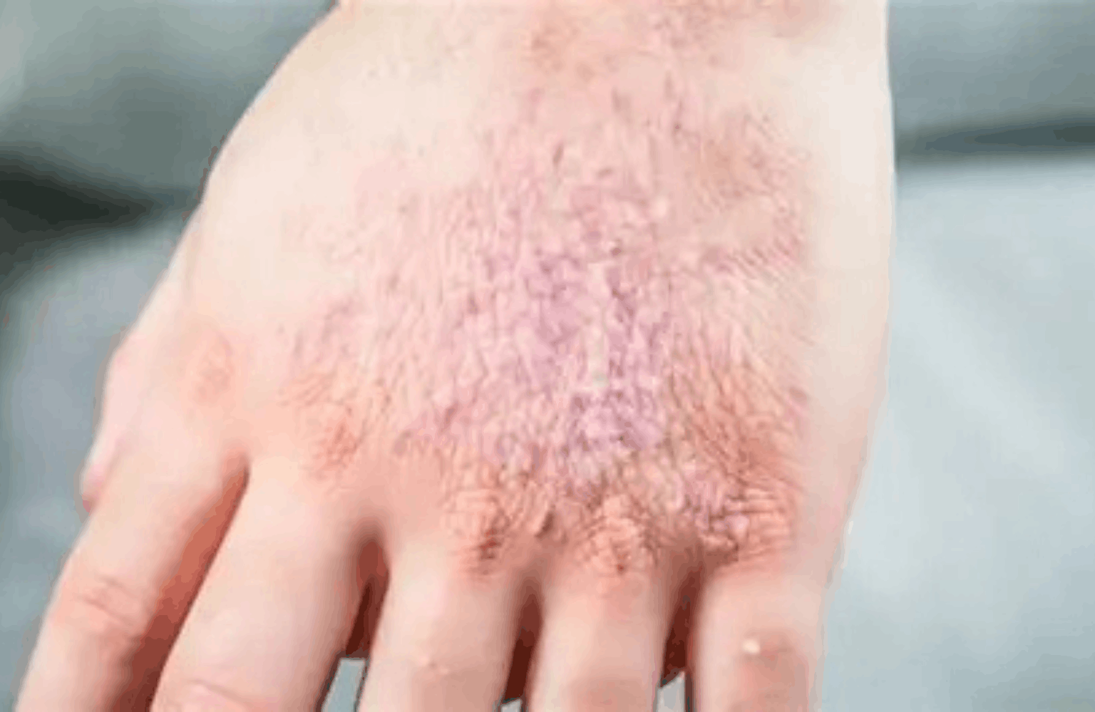 Dermatitis Ayurvedic Treatment | Causes & Symptoms